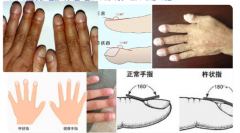 杵状指与正常手指对比，发现早期肺癌症状一个很简单的方法